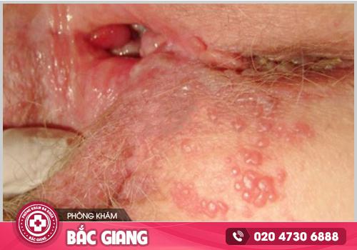 Chia sẻ hình ảnh ngứa vùng kín để nhận biết và điều trị