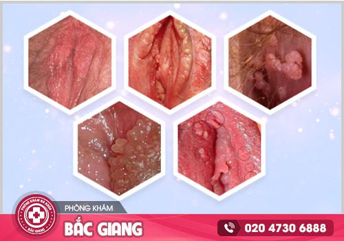 Chia sẻ hình ảnh ngứa vùng kín để nhận biết và điều trị