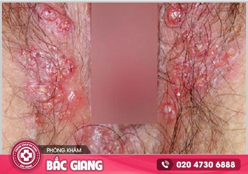 Chia sẻ hình ảnh ngứa vùng kín để nhận biết và điều trị