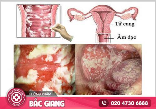 Chia sẻ hình ảnh ngứa vùng kín để nhận biết và điều trị