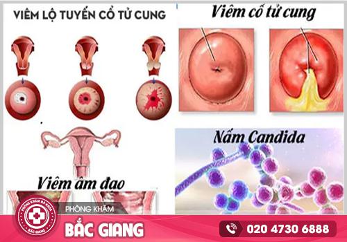 Huyết trắng bất thường - Dấu hiệu cảnh báo bệnh phụ khoa nguy hiểm